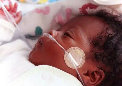 Close-up of a baby lying down, with an oxygen tube attached to their nose and a small adhesive pad on their cheek. The baby is wrapped in a white blanket with a colorful design, receiving out of hours care.