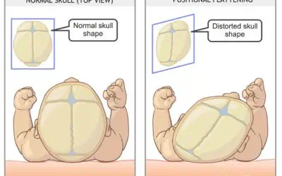 Flat Head (Plagiocephaly)