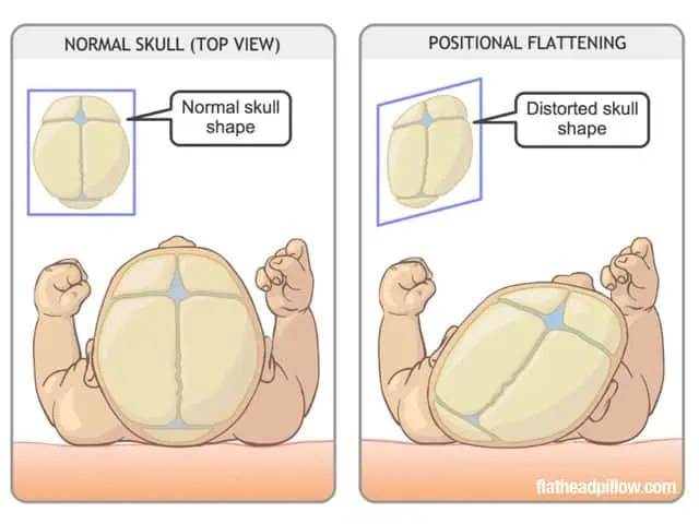 Flat Head (Plagiocephaly)