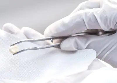 A gloved hand holding metal forceps is seen grasping a small object over a piece of white cloth.