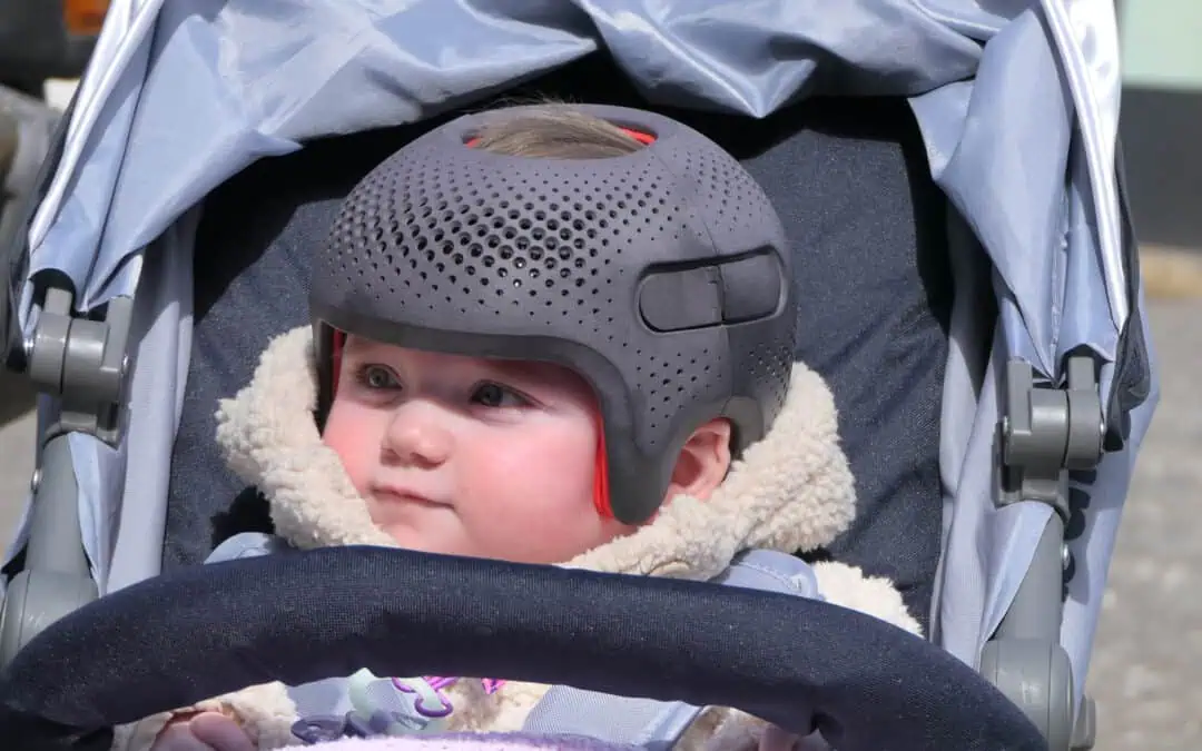 Flat Head (Plagiocephaly)