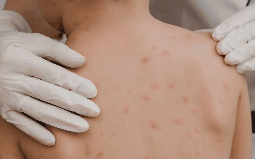 Public Health confirms 6 chickenpox cases