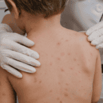 Stock photo: includes child with chickenpox being examined by a pediatrician