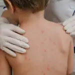 Stock photo: includes child with chickenpox being examined by a pediatrician