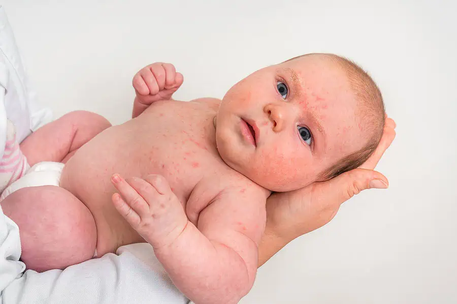 Baby with a newborn infection or allergic condition