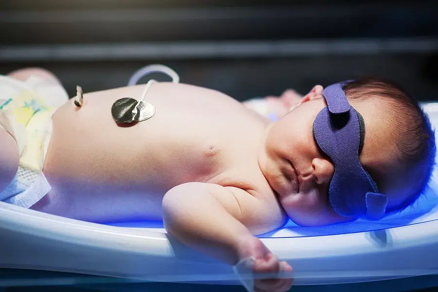 Baby with jaundice undergoing phototherapy