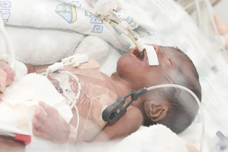 Intubated baby with RDS